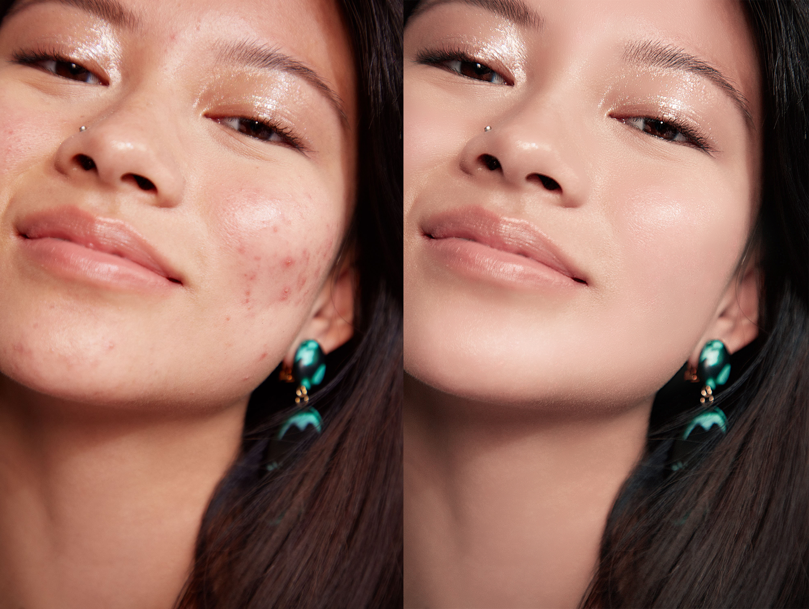 acne2.jpg