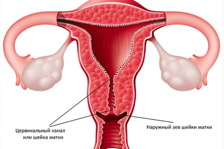 Рак шейки матки