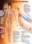 Тромбоз глубоких вен (EN>RUS)