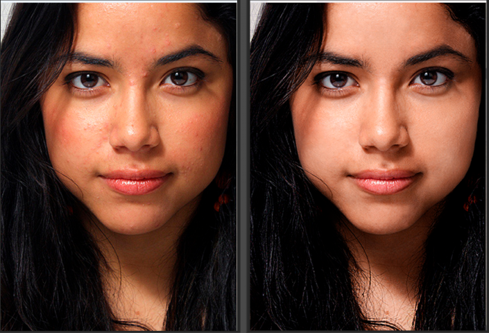 кожа с акне