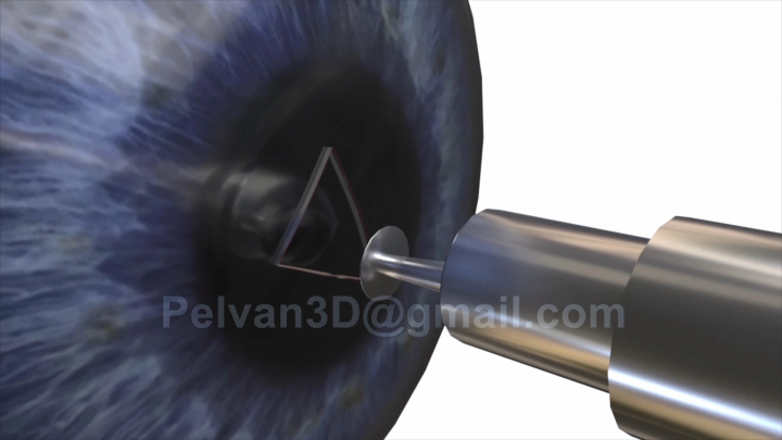 Процесс операции глаза