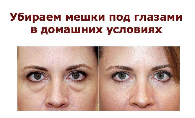 Убираем мешки под глазами, отёчность в домашних условиях