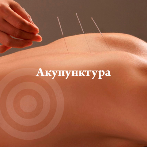 Акупунктура