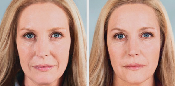 Биоревитализация: суть, эффективность, достоинства