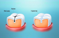 Что такое герметизация фиссур и для чего она нужна?