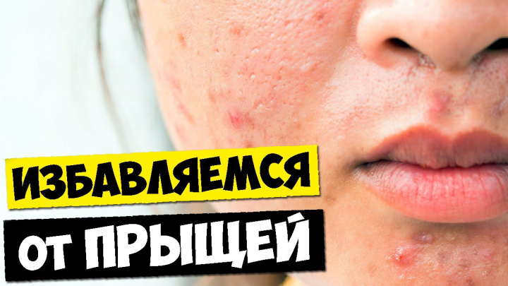 Как навсегда избавиться от прыщей?