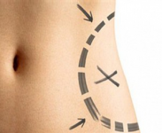 Хирургия ожирения и липосакция