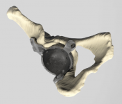 Имплантат тазобедренного сустава