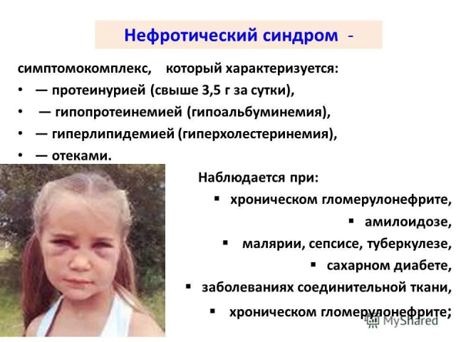 Нефротический синдром у детей