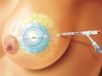 Восстановление груди в клинике Ассута в Израиле