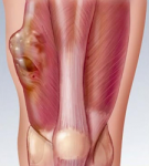 Лечение саркомы мягких тканей в Израиле