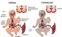 Гипоксия у плода и новорожденного — причины, симптомы, лечение