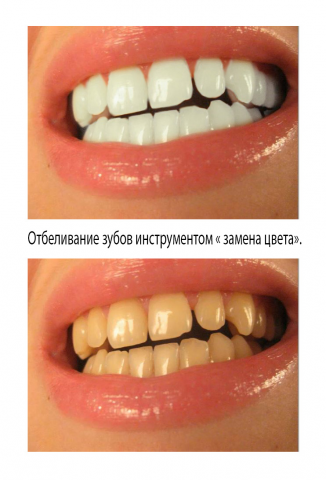 Отбеливание зубов.