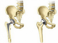 Деформирующий коксартроз