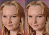 Коррекция несовершенств