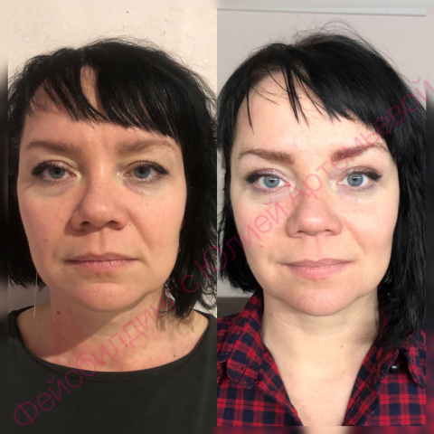 Результат за 5 недель.Эффект блефаропластики
