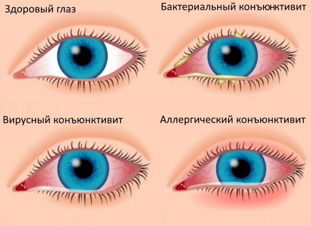 Чем опасен детский конъюнктивит?