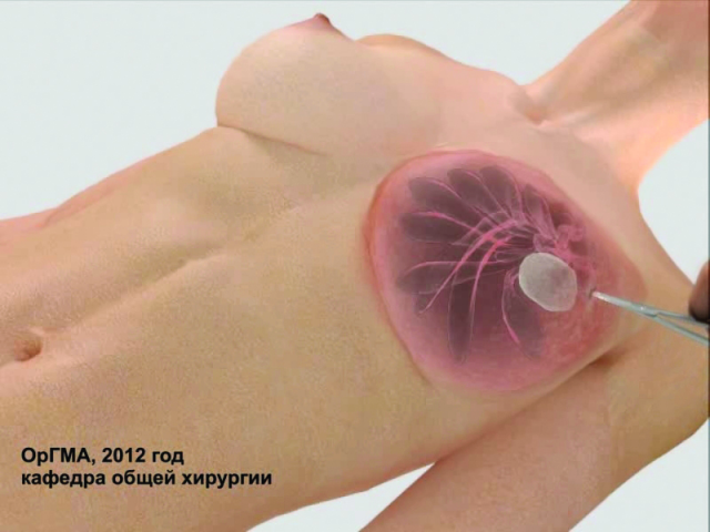 Презентация методики лечения мастита