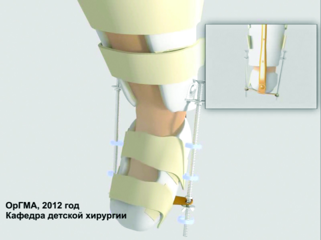 Презентация методики лечения косолапости у детей