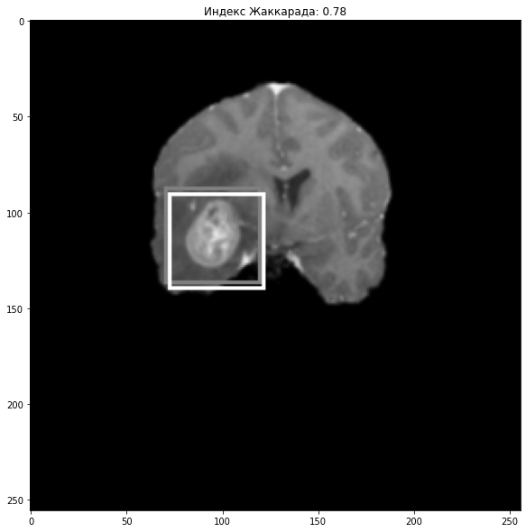 Определение опухоли мозга по снимкам МРТ