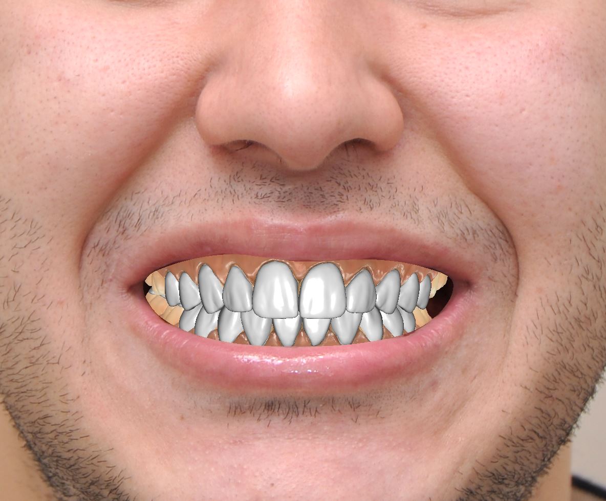 Исаев Виниры.JPG