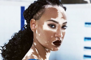 Когда лечение витилиго противопоказано