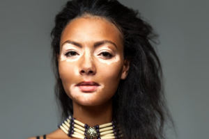 Витилиго и вопрос наследственности: информационная статья