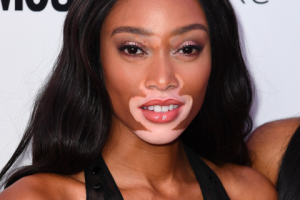 Витилиго: аутоиммунное заболевание