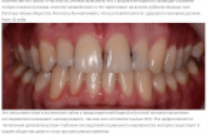 Кариес и бедность – неразлучный тандем