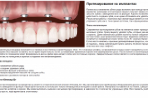 Протезирование на имплантах
