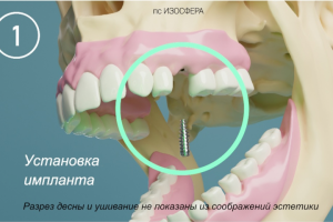 Дентальная имплантация. Ролик медицинской анимации.