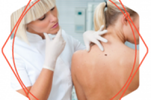 Медицинский копирайтинг: удаление бородавок