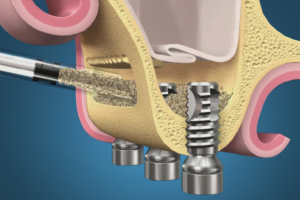 Синус лифтинг