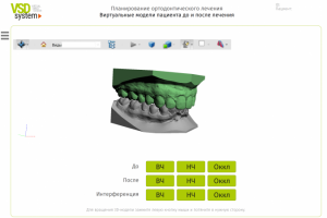 Работа с трехмерными моделями челюстей пациентов