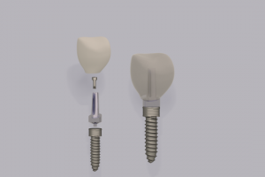 зубной имплантант