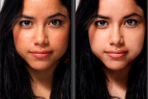 кожа с акне