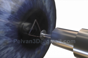 Процесс операции глаза