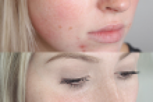 Удаление дефектов с кожи