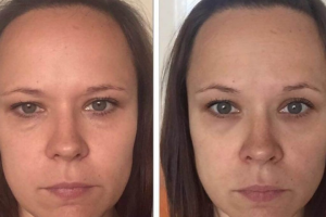 Лимфомиазот, средство от отёков.