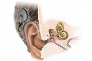 Имплант для уха_Mi_1000 (Клиническая экспертиза)_89 стр.