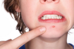 Причины прыщей на лице