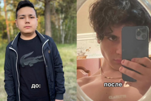 Область - лицо, прическа (безоперационно)