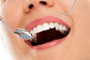 Профессиональная гигиена полости рта