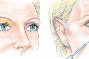 Липофилинг век