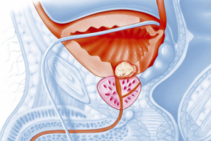Симптомы и лечение хронического простатита