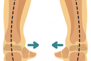 Варусная деформация стопы у детей