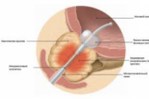 Лечение аденомы без операции