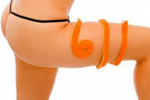 Лечение целлюлита с помощью ударно-волновой терапии