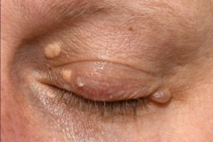 Ксантелазма