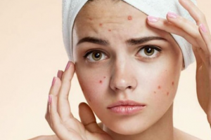 Акне в возрасте 25+